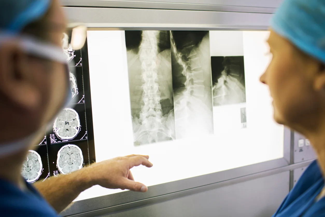 Doctors discussing patient’s X-ray and MRI scans, representing spinal cord injury cases handled by Trident Law HQ
